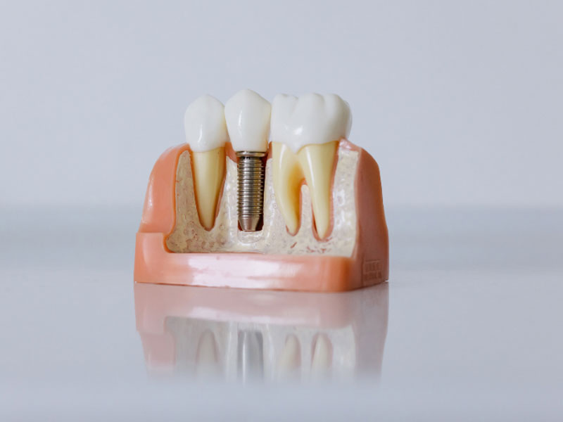 Dental Implants Bridges