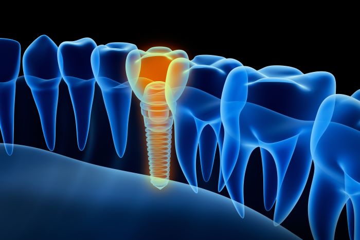 Dental Implants Compared