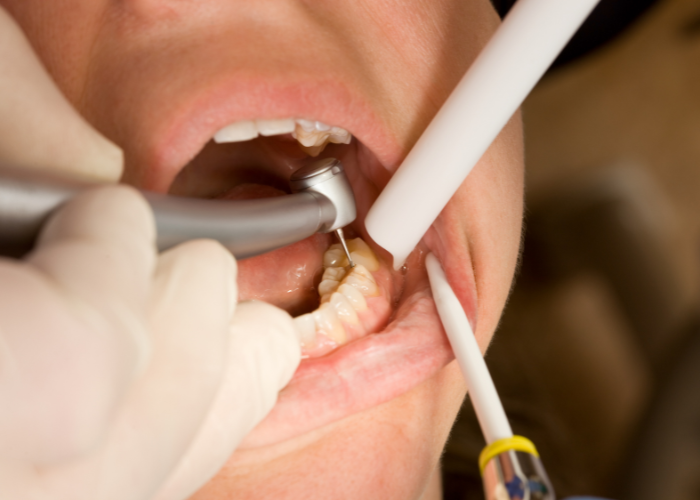 dental fillings Moses Lake