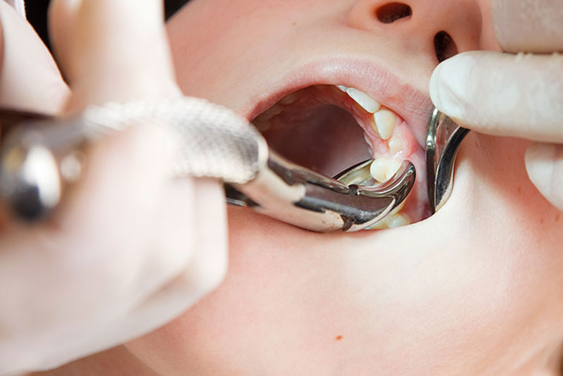 Hasil gambar untuk Tooth Extractions